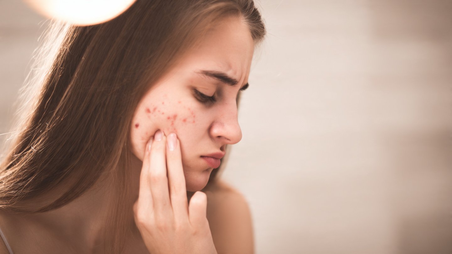 Bài Thuốc Dân Gian Trị Mụn Do Nóng Gan Hiệu Quả – Giải Độc Từ Bên Trong